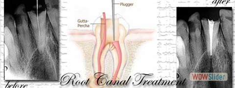 01 root canal treatment