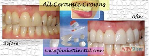 all ceramic crown10