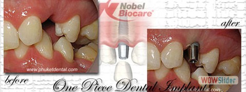 dental_implant02