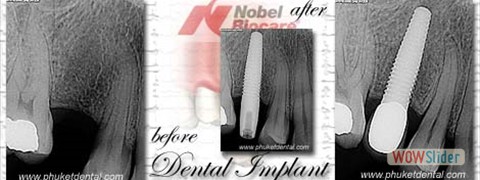 dental_implant_xray10