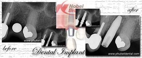 Dental Implants by Phuket Dentist at Phuket Dental Clinic in Phuket,Thailand