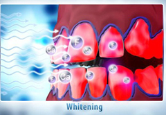 Natural Plus Tooth Whitening at Phuket Dental Clinic,Thailand