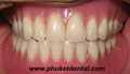 Complete Denture/Full Denture at Phuket Dental Clinic,Thailand