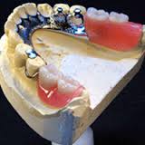 vitallium partial denture:Phuket Dental clinic,Thailand